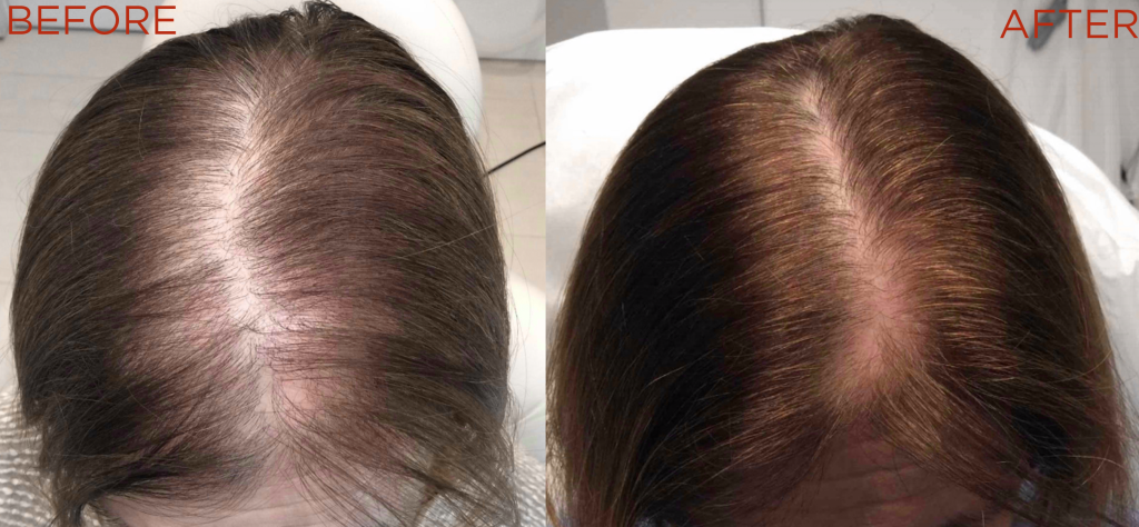 How does PRP hair loss therapy work?