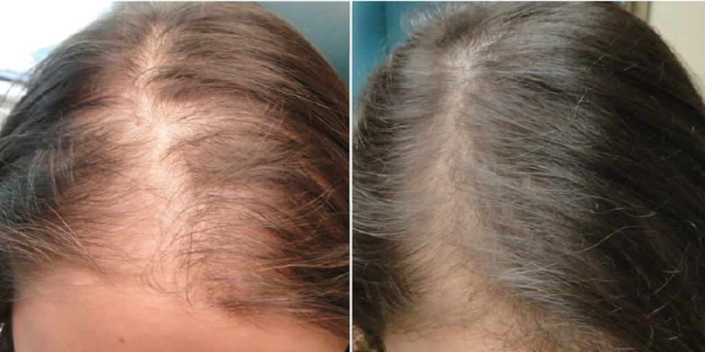 PRP hair loss therapy in Cincinnati