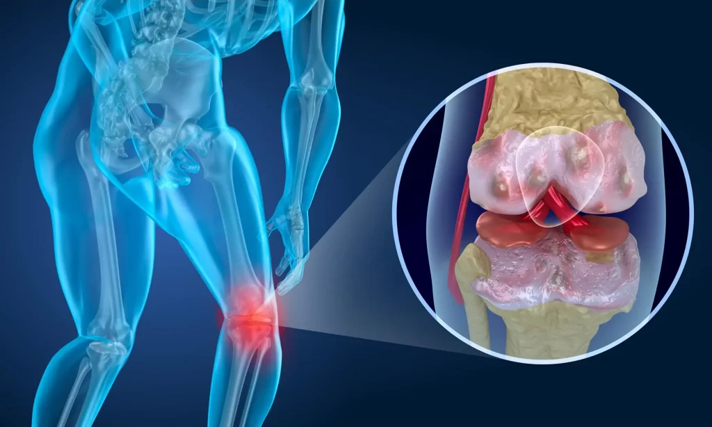 Stem cell therapy for knee pain