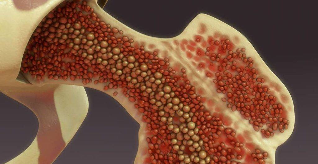 Bone Marrow Aspirate Concentrate